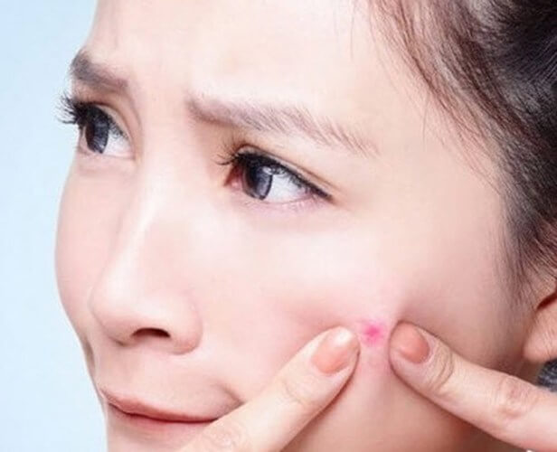 5 bước nặn mụn đúng cách không để lại sẹo và vết thâm 7