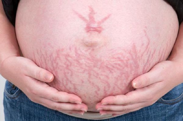 5 cách đối phó với rạn da trong thai kỳ an toàn 25