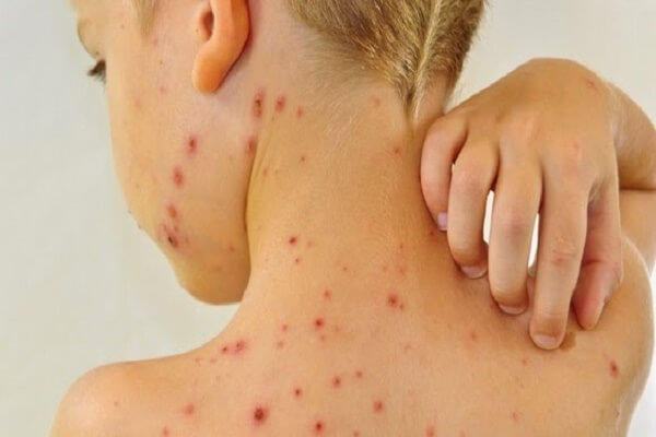 Các virut gây ra bệnh về da