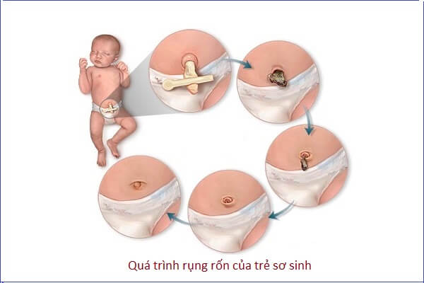 Các bước vệ sinh và chăm sóc dây rốn bé yêu đúng cách 6