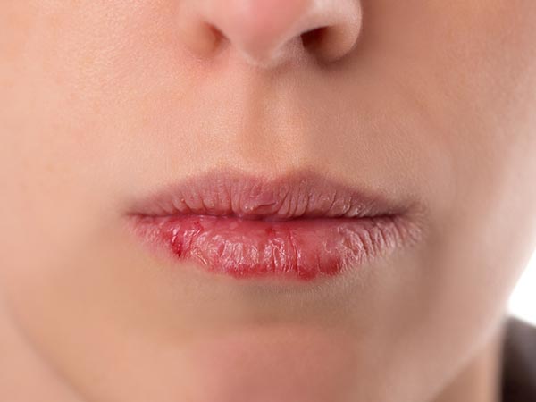 Đôi môi và những dấu hiệu cảnh báo sức khỏe 11