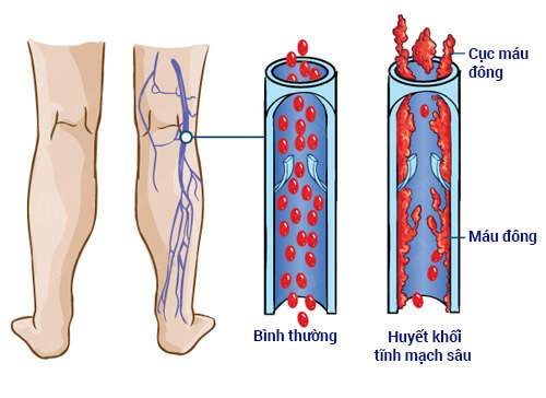 Huyết khối tĩnh mạch khi mang thai nguy hiểm như thế nào? 6