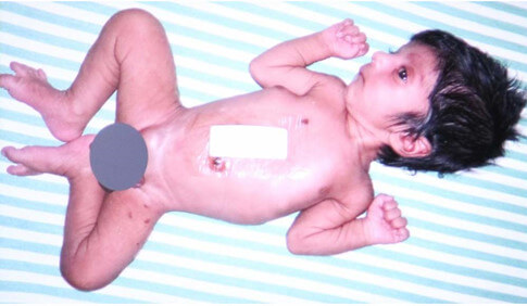 Phẫu thuật cứu sống bé trai có 4 chân, 2 cơ quan sinh dục 6