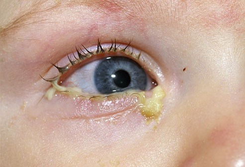 Tất tần tật những điều ba mẹ cần biết để phòng tránh bệnh đau mắt đỏ ở trẻ em 4