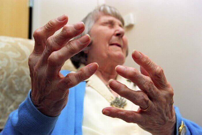 Bẻ khớp ngón tay và những hệ lụy khôn lường cho sức khỏe 6