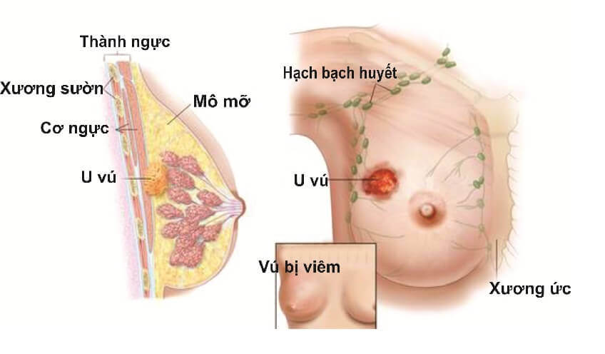 Cách điều trị viêm xơ tuyến sữa và những điều cần biết 5