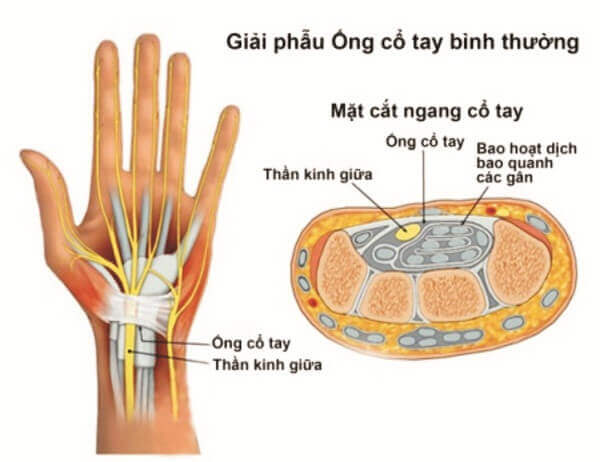 Hội chứng ống cổ tay là gì, cách điều trị ra sao? 6