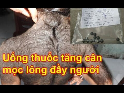 Uống thuốc tăng cân, bé gái 7 tuổi mọc lông khắp người 6