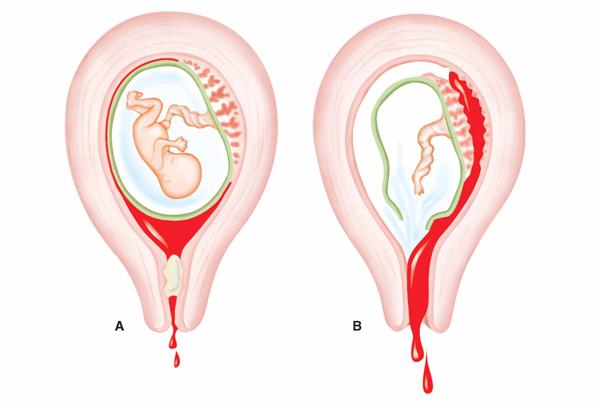 Vỡ tử cung tai biến sản khoa cực kỳ nguy hiểm cho mẹ bầu 7