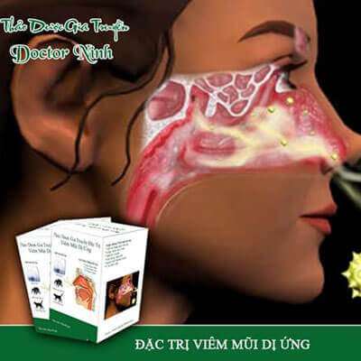 Thảo dược gia truyền Doctor Ninh đặc trị viêm mũi dị ứng 3