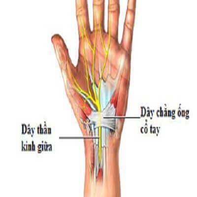 Hội chứng ống cổ tay là gì, cách điều trị ra sao? 5