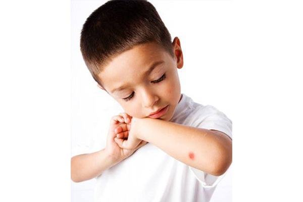 7 mẹo trị lành sẹo do côn trùng gây ra cho bé 5