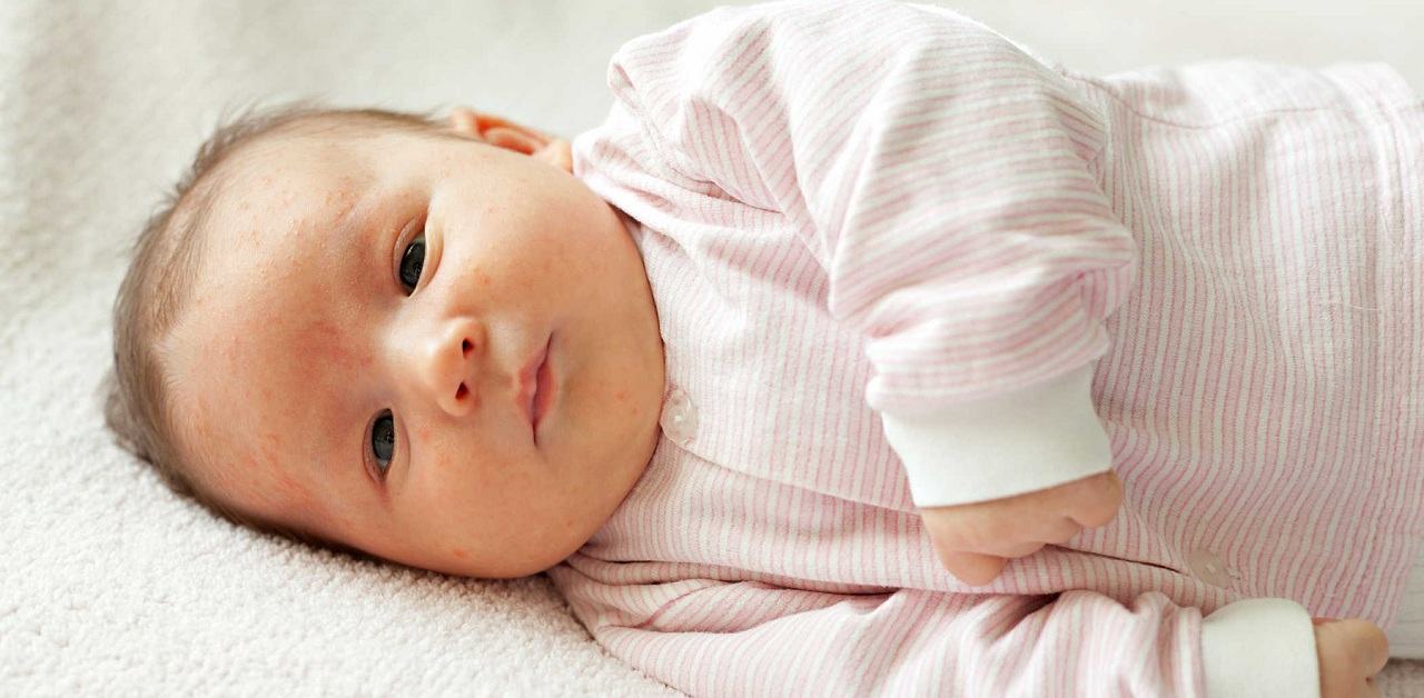Mụn sữa ở trẻ sơ sinh và những điều mẹ nên biết 4