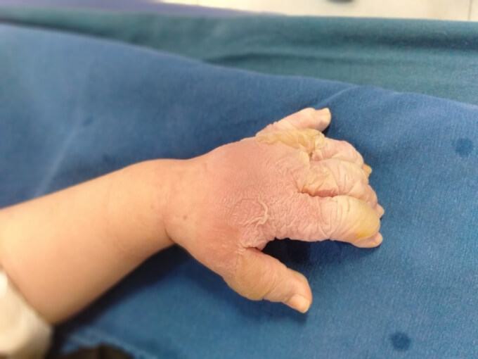 Bé gái 2 tháng tuổi bị nhỏ nhầm axit vào miệng 37 Bé gái 2 tháng tuổi bị nhỏ nhầm axit vào miệng 18