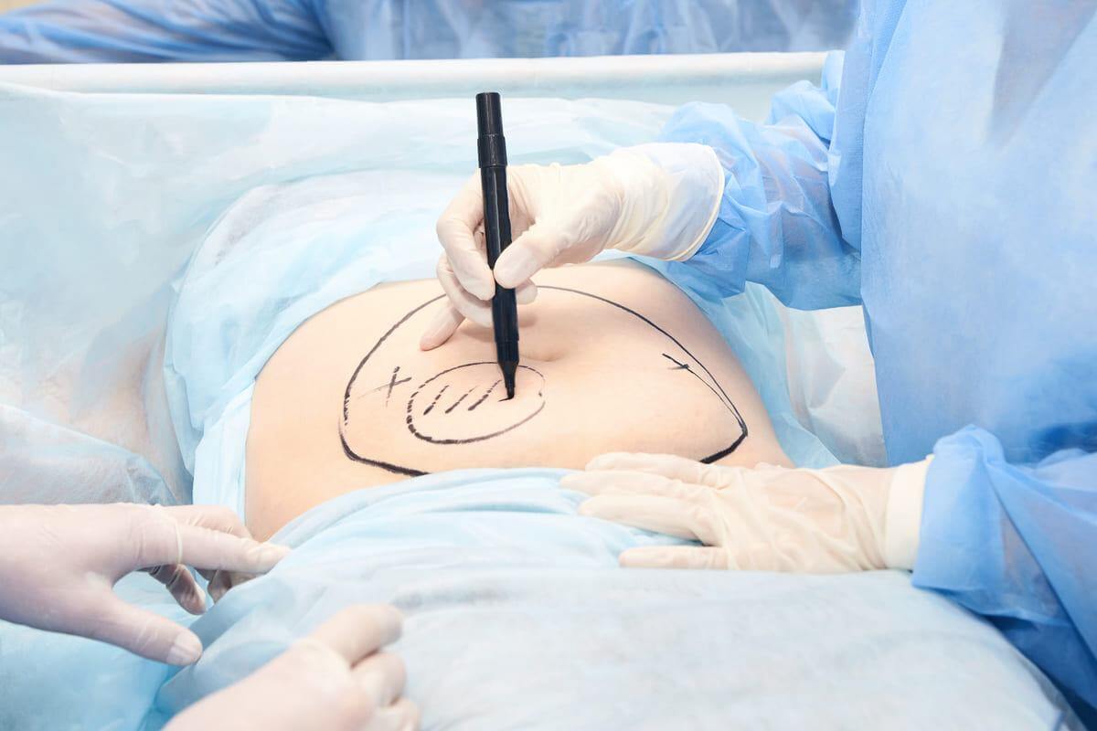 mổ cắt tử cung qua ổ bụng