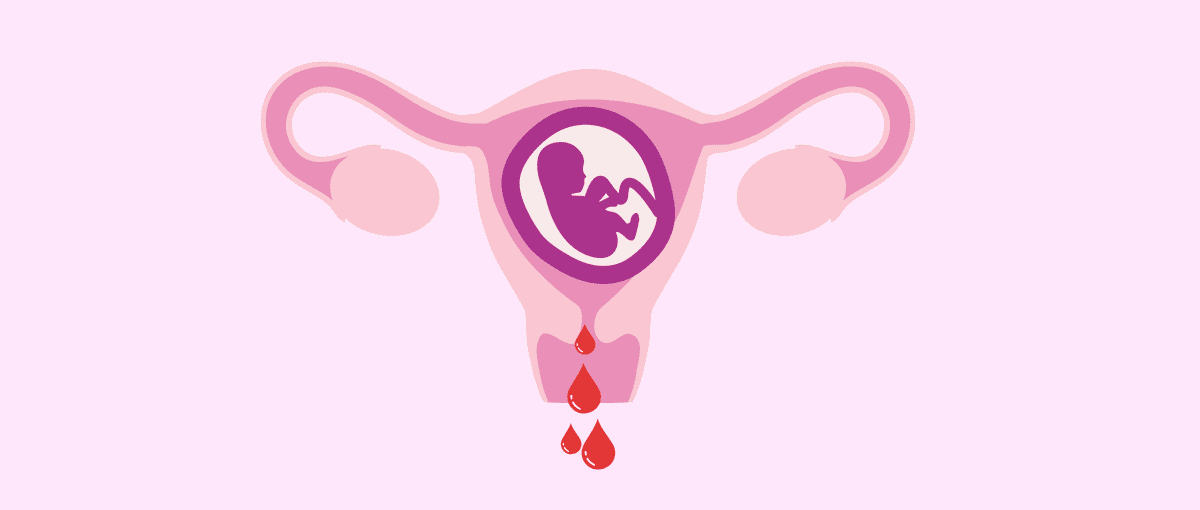 ra máu trong thai kỳ