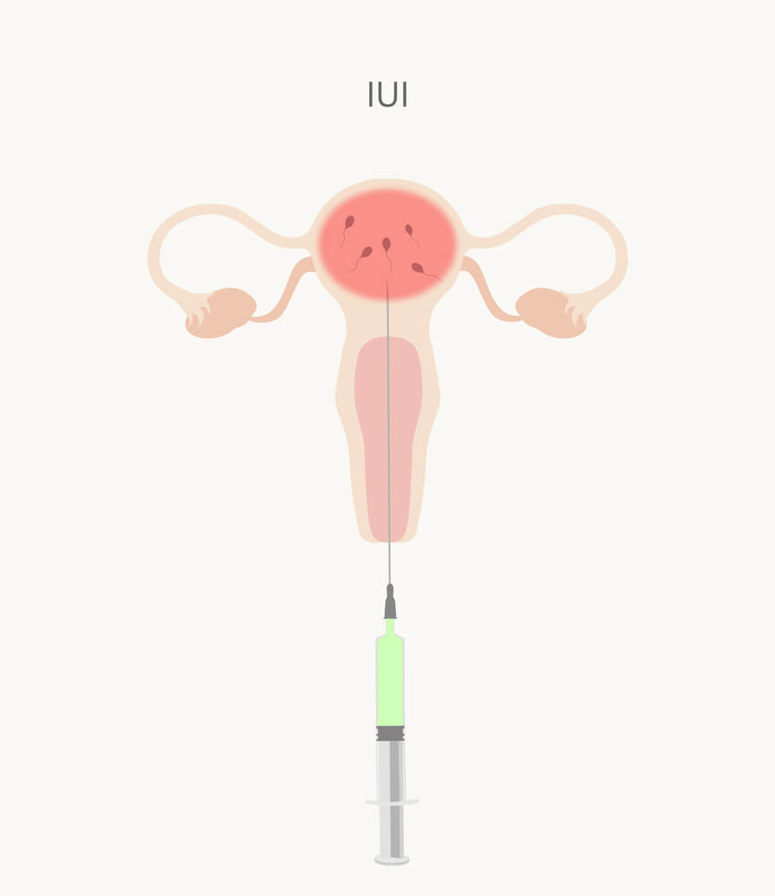cách bơm tinh trùng vào buồng tử cung