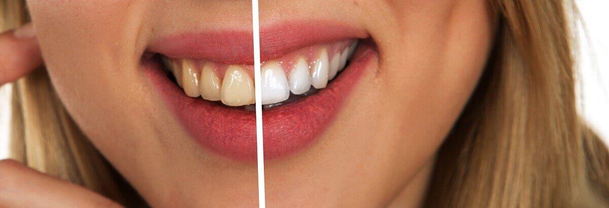 răng bị vàng
