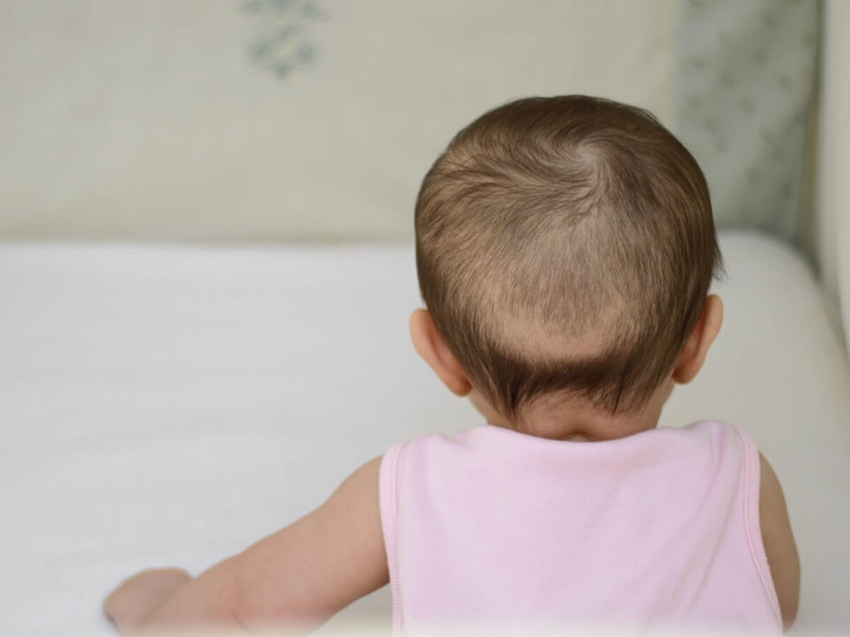 hình ảnh rụng tóc vành khăn ở trẻ sơ sinh 