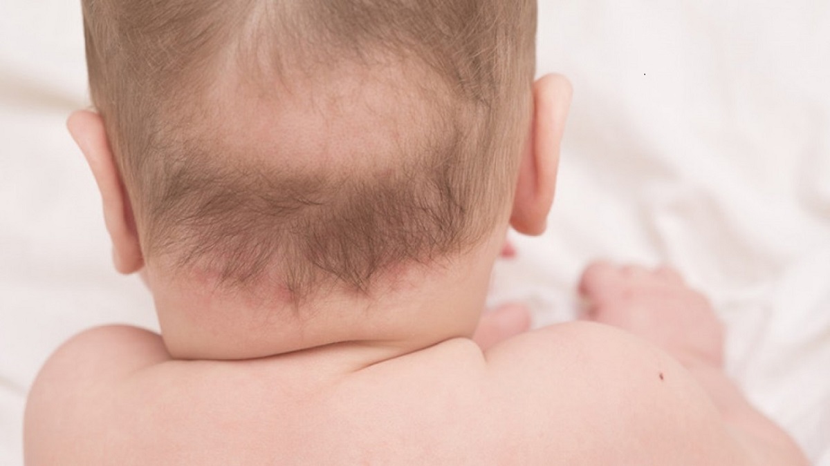 hiện tượng rụng tóc vành khăn ở trẻ sơ sinh