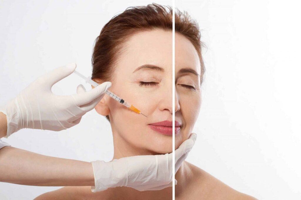 Cấy collagen tươi