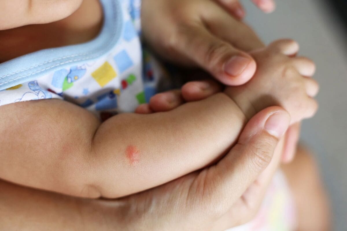 Dấu hiệu nhận biết trẻ sơ sinh bị muỗi đốt