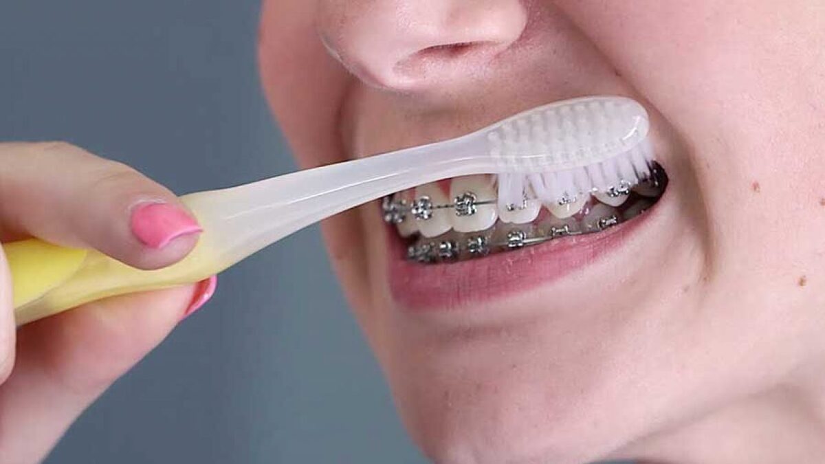 cách vệ sinh răng miệng sau khi niềng răng