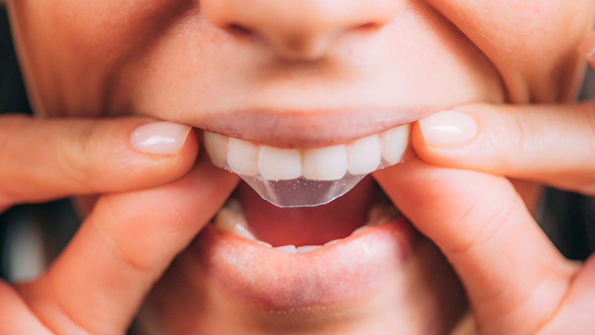 cách sử dụng miếng dán trắng răng chính xác