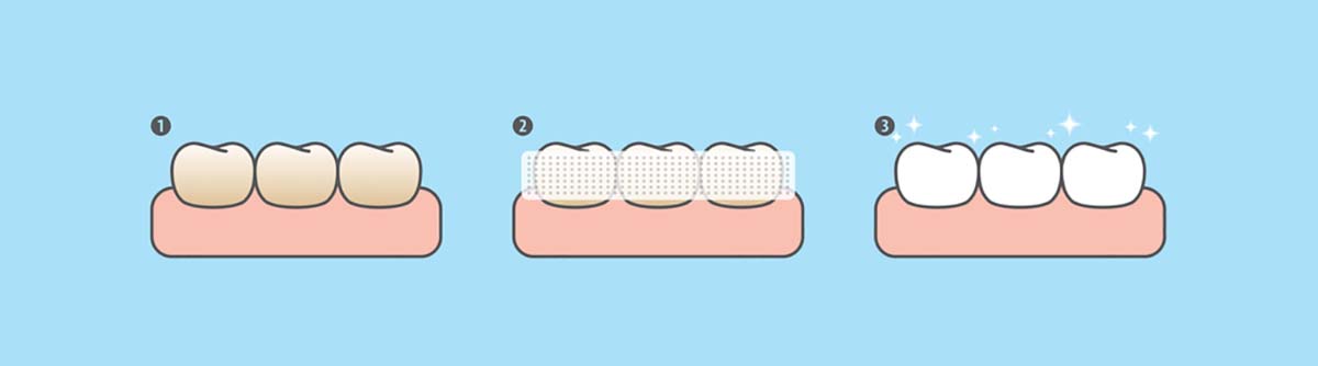 cách sử dụng miếng dán trắng răng và các bước làm