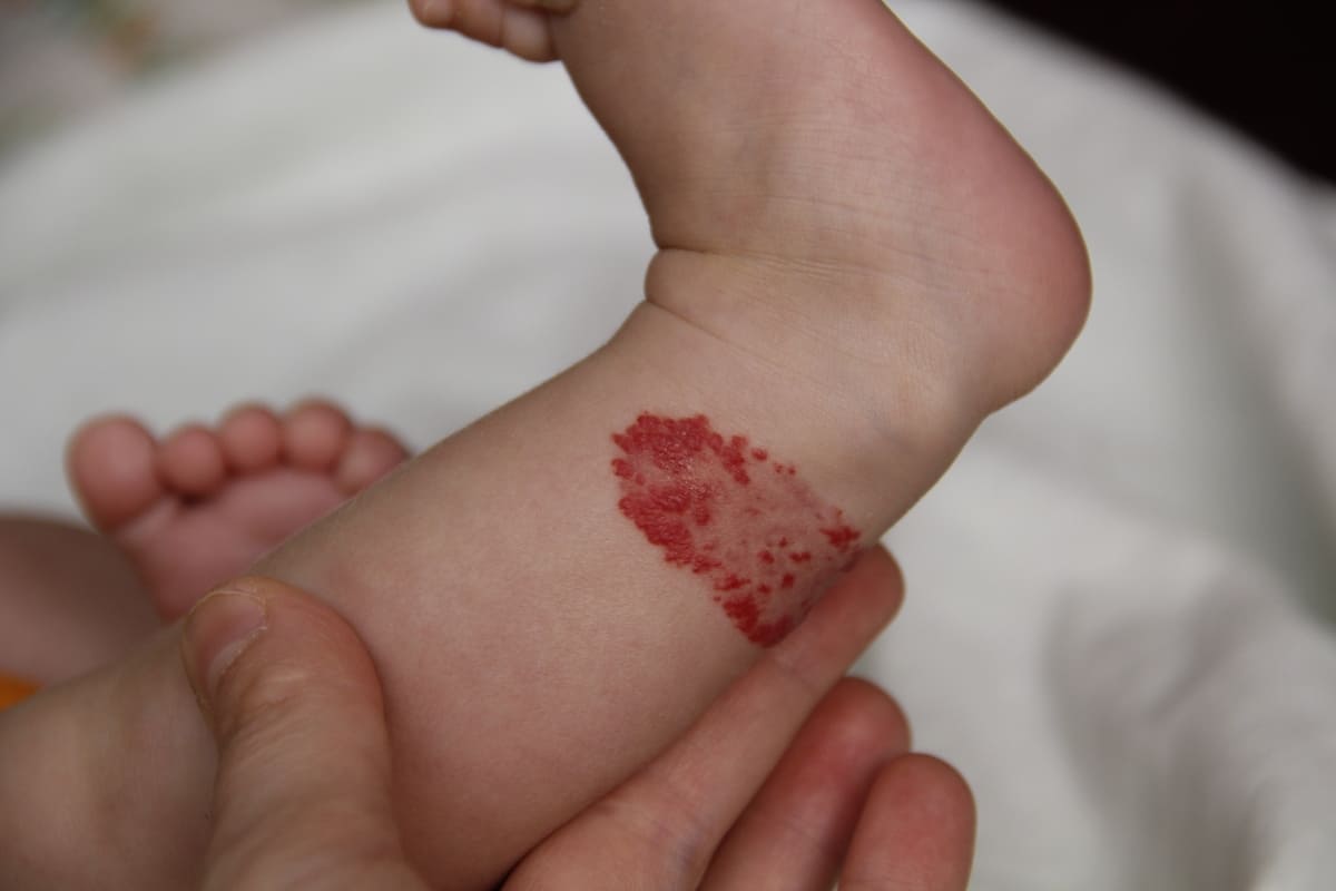 u máu ở trẻ sơ sinh có nguy hiểm không