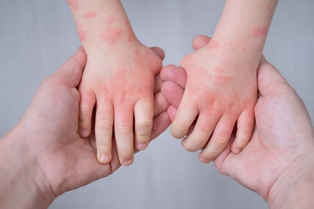 Trẻ bị chàm tay: Dấu hiệu, phân loại và cách điều trị