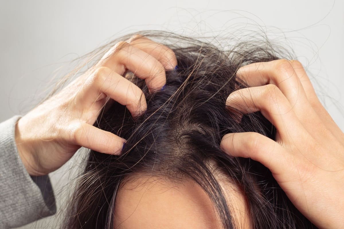 10 nguyên nhân da đầu gàu và ngứa