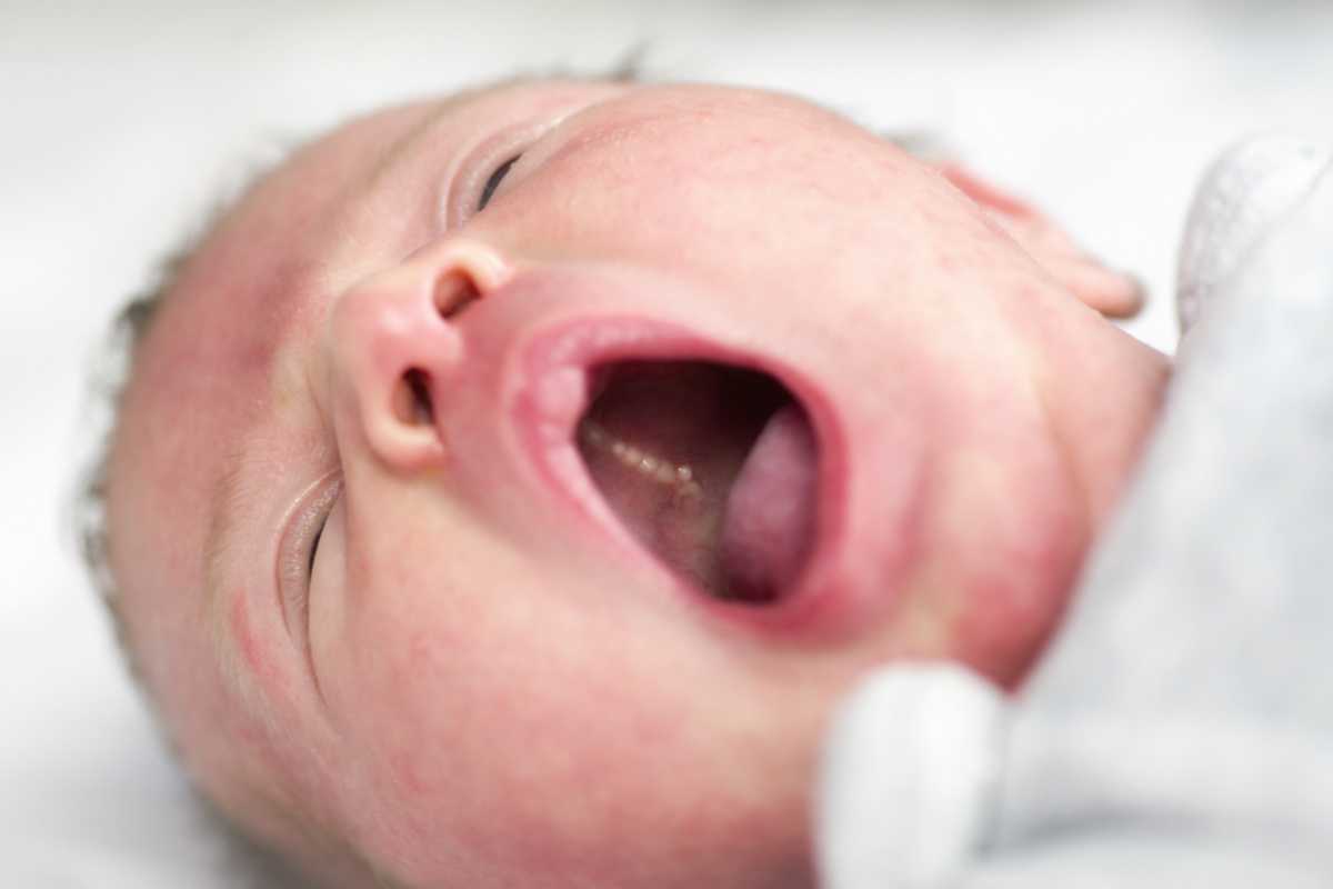 Có nên nhổ nanh sữa ở trẻ sơ sinh không?