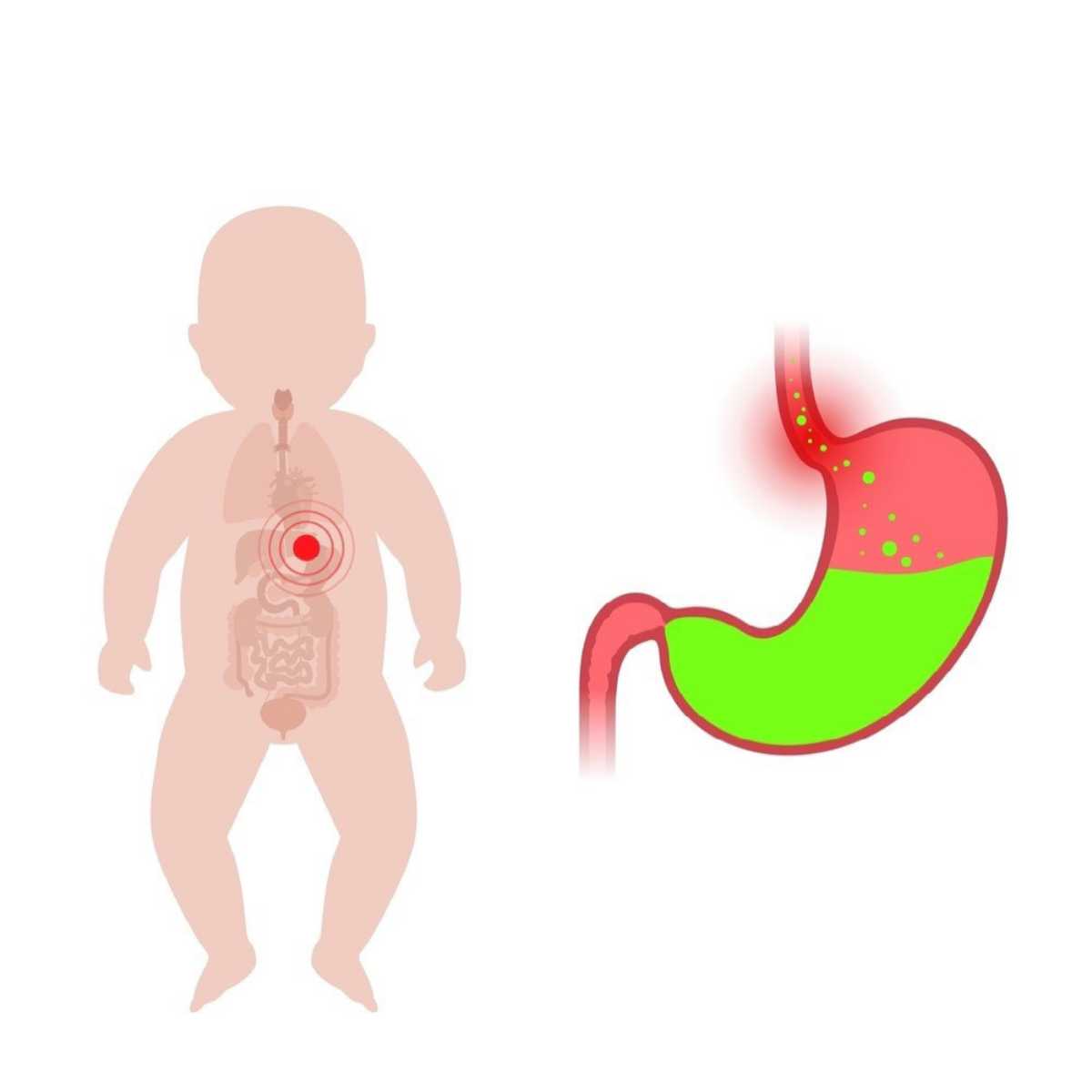 trẻ sơ sinh nằm nghiêng có thể gây trào ngược dạ dày
