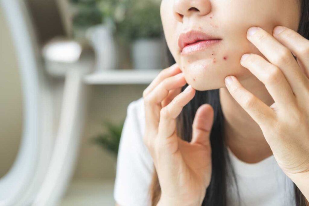 Da mặt đột nhiên nổi nhiều mụn: Nguyên nhân và cách điều trị 3