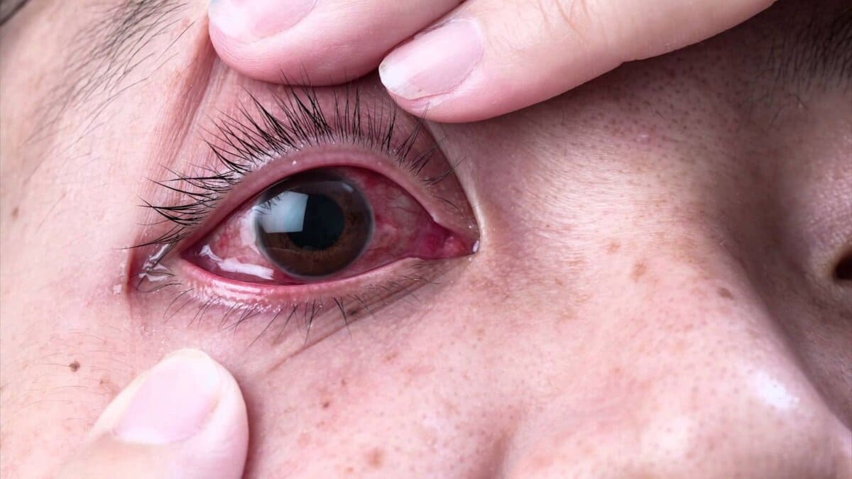 bệnh đau mắt đỏ
