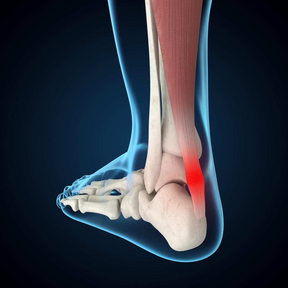 đau gót chân là bị gì là viêm gân achilles