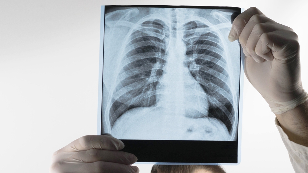 tìm dấu hiệu bệnh lao phổi thông qua kết quả chụp x-quang