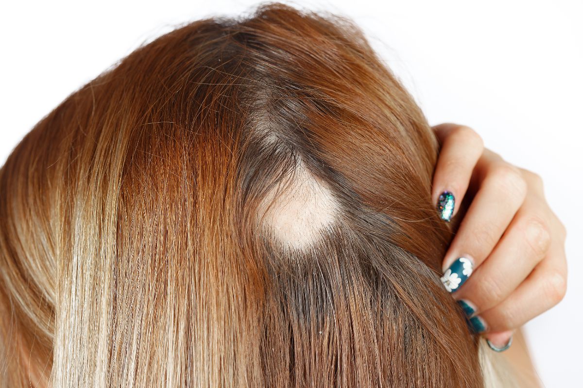 Giải pháp hiệu quả khắc phục rụng tóc hói đầu ở phụ nữ
