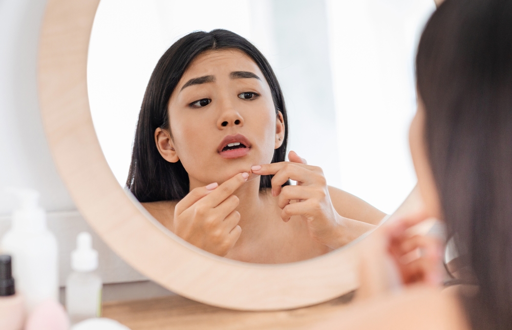cách trị mụn tại nhà​