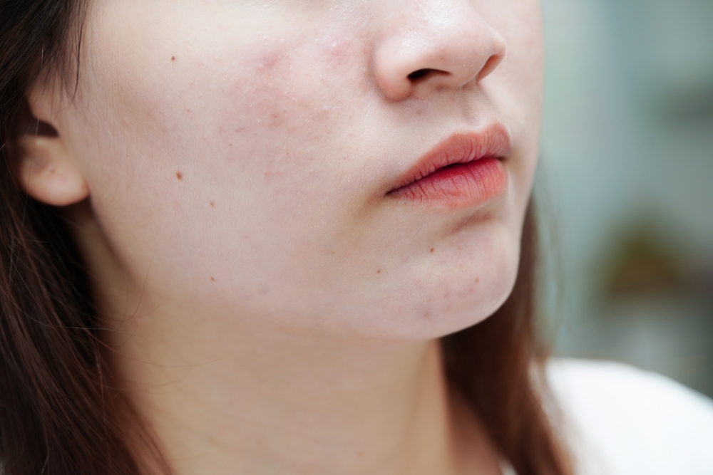 da dầu mụn nên dùng gì​ và hiểu đúng về da dầu mụn