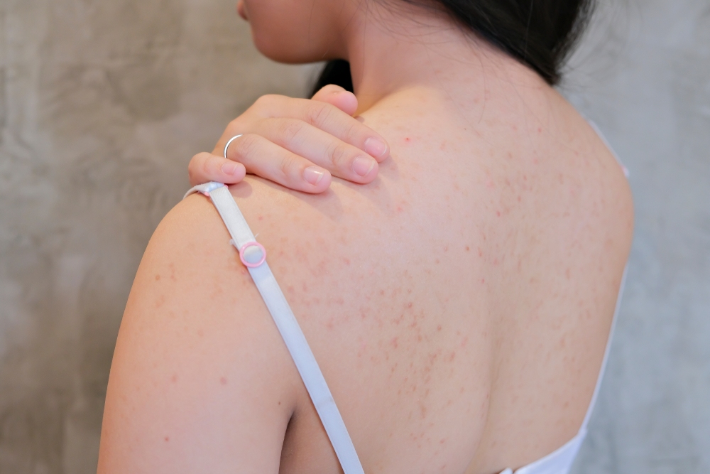 trị mụn lưng​ và nguyên nhân gây mụn lưng