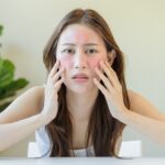 cách trị dị ứng mỹ phẩm tại nhà nhanh nhất​