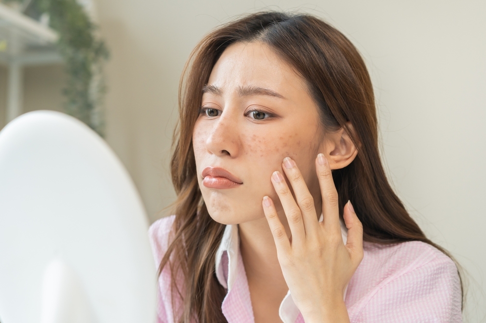 cách trị nám gò má tại nhà​