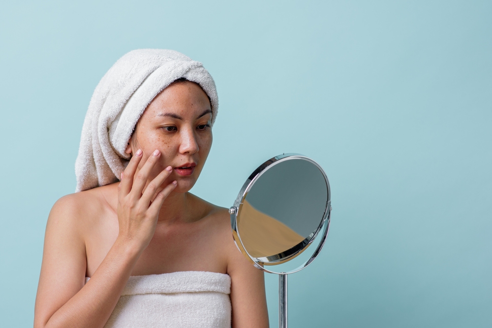 cách trị nám gò má tại nhà​ và nám gò má là gì