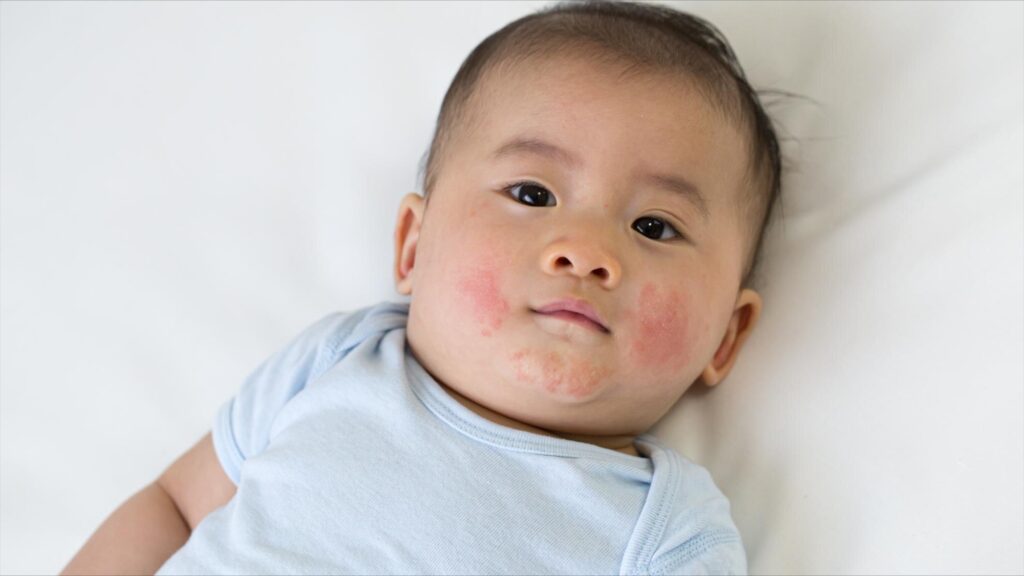 chàm sữa ở trẻ sơ sinh​
