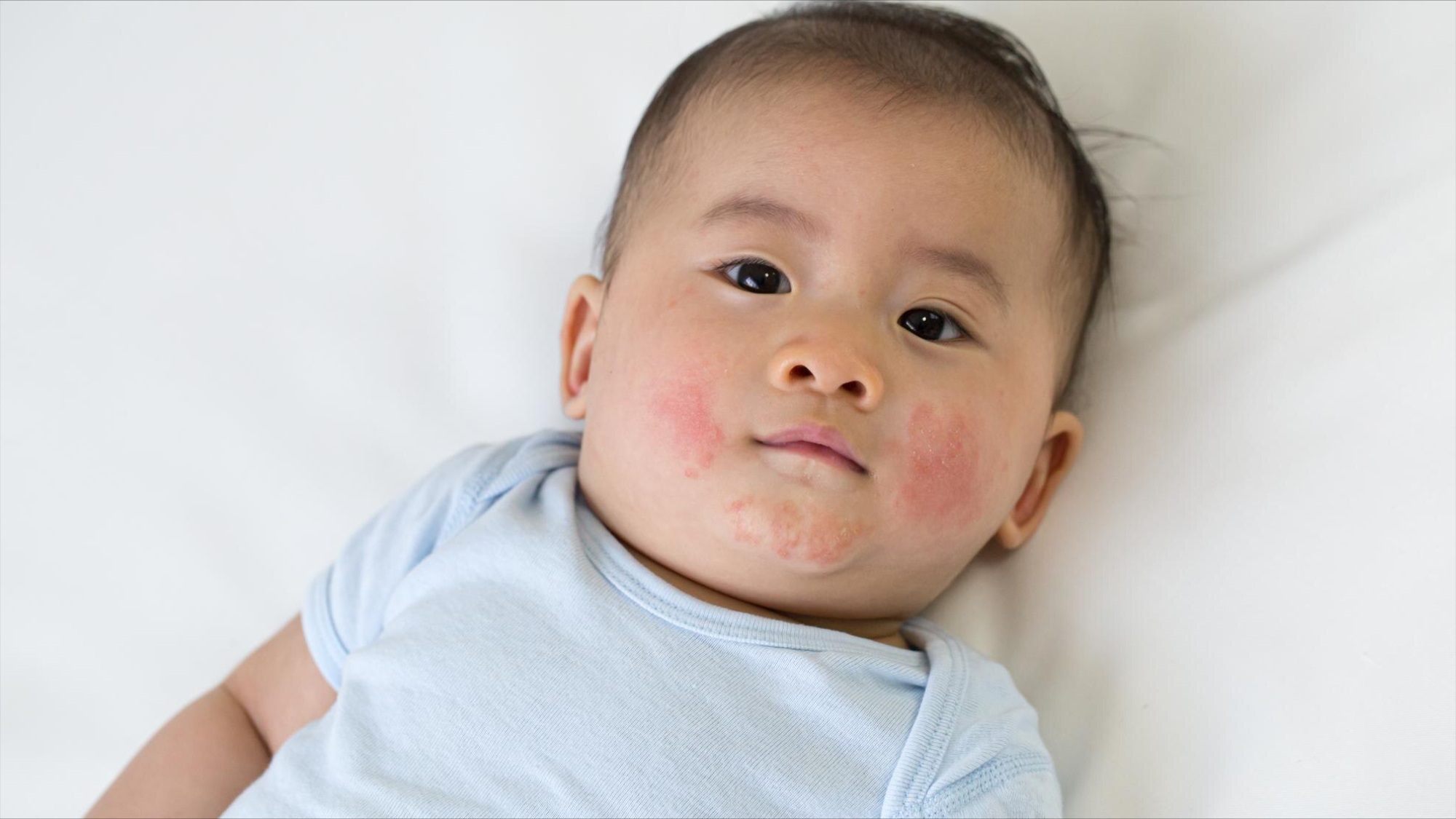 chàm sữa ở trẻ sơ sinh​