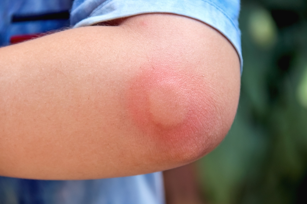 các mẹo dân gian chữa ong đốt từ nguyên liệu tự nhiên 10 mẹo dân gian chữa ong đốt từ nguyên liệu tự nhiên