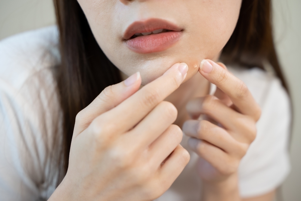 cách chăm sóc da sau khi lấy nhân mụn​