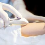 cấy que tránh thai có an toàn không​